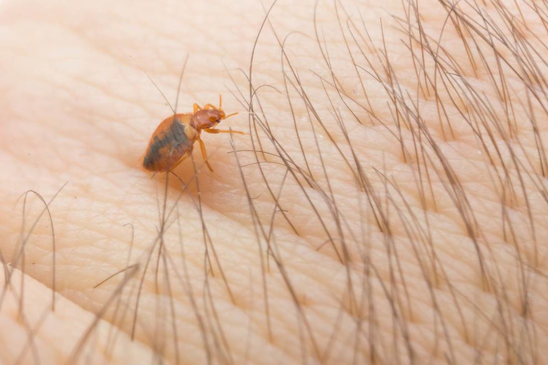 Picture of bed bug on a person in Baton Rouge Louisiana