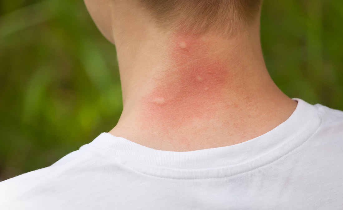 Picture of mosquito bites on the neck of a young man in baton rouge louisiana